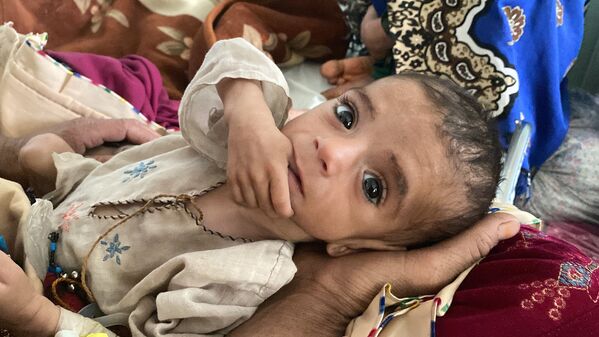 کودک مبتلا به سوء تغذی در افغانستان - اسپوتنیک افغانستان  