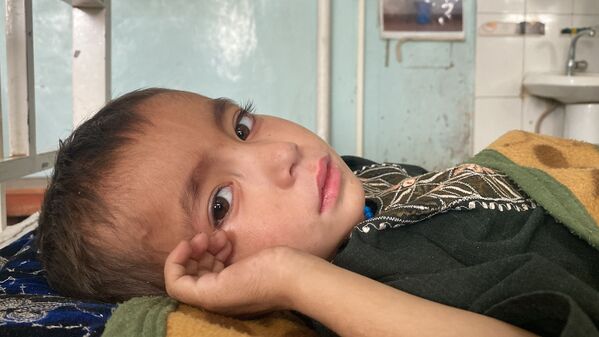 کودک مبتلا به سوء تغذی در افغانستان - اسپوتنیک افغانستان  