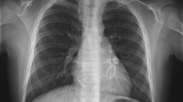 Рентгеновский снимок легких при синдроме Кавасаки - اسپوتنیک افغانستان  