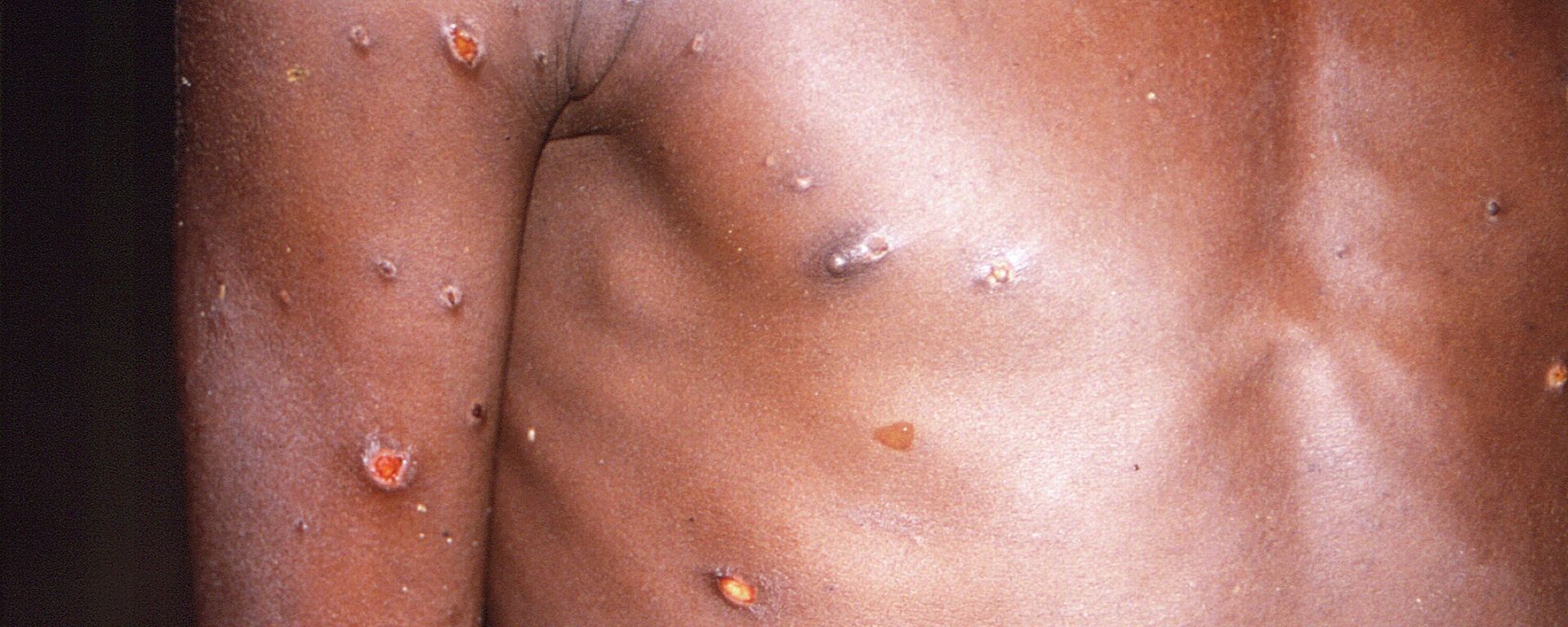 На снимке 1997 года показаны правая рука и туловище пациента, на коже которого был обнаружен ряд повреждений из-за активного случая обезьяньей оспы - اسپوتنیک افغانستان  , 1920, 14.07.2022