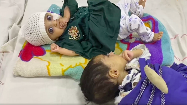 کودکان سوء تغذیه در افغانستان - اسپوتنیک افغانستان  