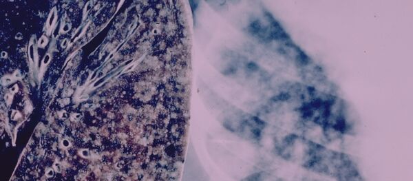 بیماری تربرکلوز سالانه جان هزاران نفر را در افغانستان میگیرد بیماری تربرکلوز سالانه جان هزاران نفر را در افغانستان میگیرد - اسپوتنیک افغانستان