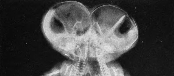 Рентгеновский снимок сиамских близнецов. Архивное фото Рентгеновский снимок сиамских близнецов. Архивное фото - اسپوتنیک افغانستان