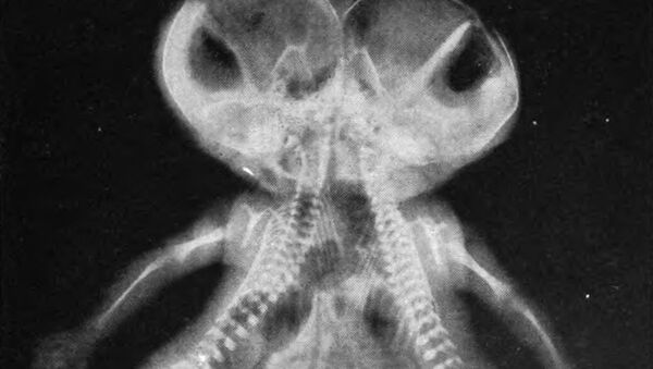 Рентгеновский снимок сиамских близнецов. Архивное фото - اسپوتنیک افغانستان  