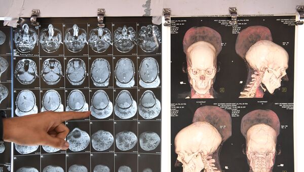 جراحی موفقانه بزرگترین تومور مغزی جهان در هند + عکس - اسپوتنیک افغانستان  