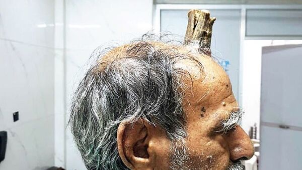 درآمدن شاخ 10 سانتی بر روی سر یک مرد - اسپوتنیک افغانستان  